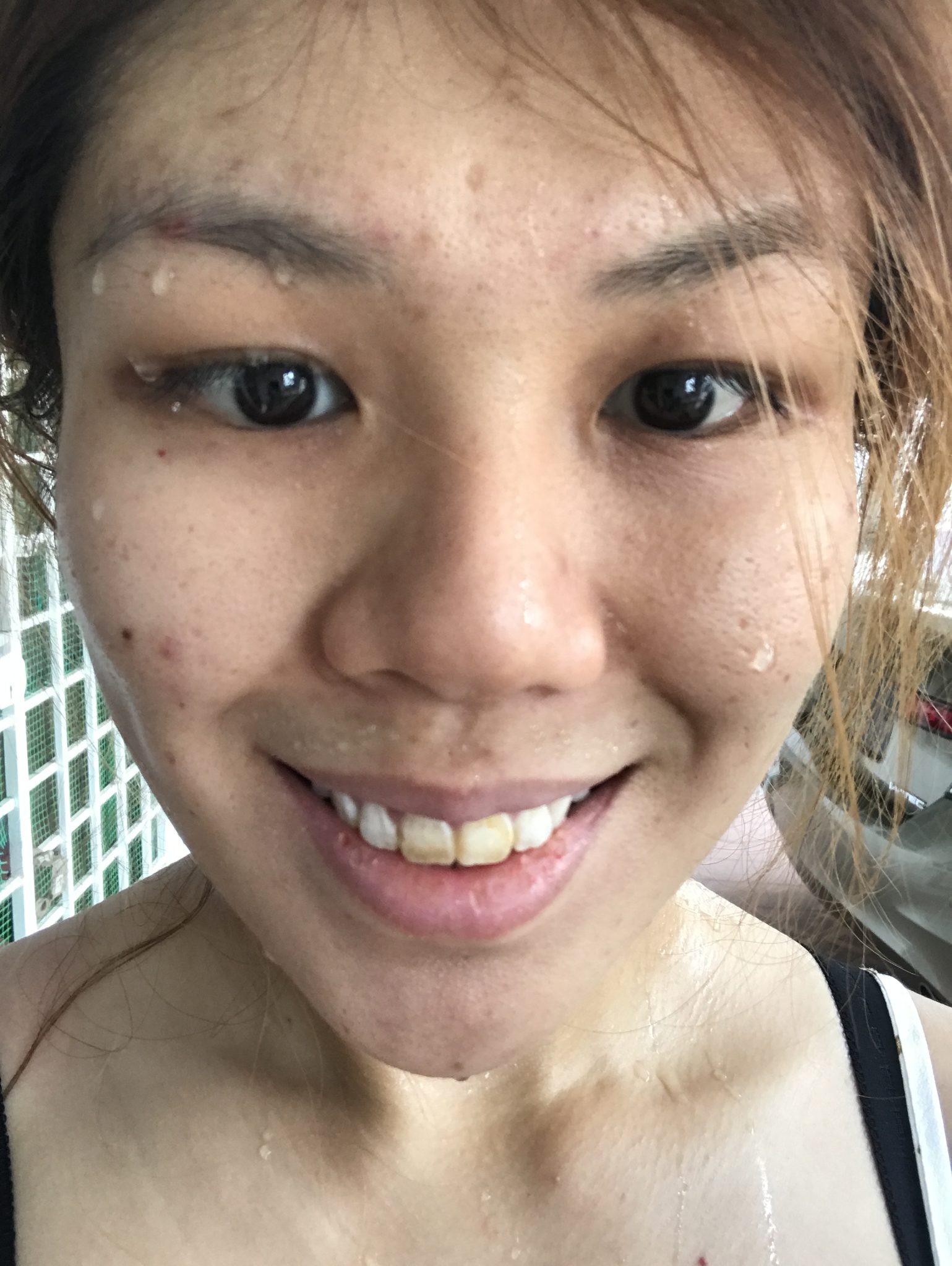 Hyperhidrosis on the Scalp PUCHONGIAN 蒲种人